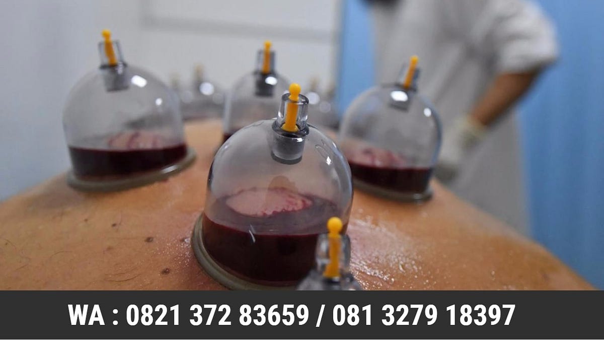 Bekam Tradisional untuk Kesehatan Keluarga di Cilacap